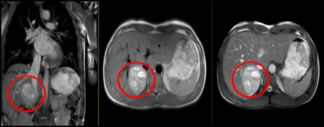 Figure 2 Incidental finding of right adrenal tumour (phaeochromocytoma) on cardiovascular magnetic resonance