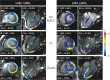 Examples of cardiovascular MR feature tracking abnormalities in different categories of left ventricular ejection fraction (LVEF) and its association with major adverse cardiac events (MACE). Global circumferential strain (GCS) and global longitudinal strain (GLS) are displayed at end systole for, A–C, patients with a reduced LVEF (< 40%) and for, D–F, patients with an LVEF greater than or equal to 40%. VT = sustained ventricular tachycardia. (Reprinted, with permission, from reference 44.)