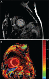 Imaging in a 60-year-old man with dilated cardiomyopathy and septal fibrosis. A, Late gadolinium enhancement (LGE) was found in the midwall of the interventricular septum (arrow). B, Non–contrast-enhanced T1 mapping shows that the native T1 value of the septal region including LGE (enclosed by a white line) is 1382.2 msec, which is more than 1349.4 msec ± 1.2 (standard deviation) above that of the minimum T1 value (enclosed by a green line, 1262.4 msec ± 62.0) in this patient. (Reprinted, with permission, from reference 29.)