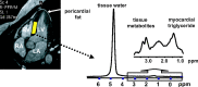 Measurement of myocardial triglyceride content by localized MR spectroscopy. Left, Cine four-chamber cardiac image. In this image, heart muscle appears dark gray; blood in myocardial chambers and pericardial and adipose fat appear light gray. The volume for testing myocardial triglyceride content is placed within the intraventricular septum (yellow rectangle). Right, Spectrum from myocardial tissue collected during simultaneous end expiration and end systole with respiratory gating and electrocardiographically guided triggering. LA = left atrium, LV = left ventricle, RA = right atrium, RV = right ventricle. (Reprinted, with permission, from reference 35.)