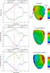 The strain curves and systolic strain maps for a patient with septal flash. Left column: Comparisons of Jacobian strain and strain computed using a postprocessing of tagged images proposed approach at V s = 1%, with radial strain (top), longitudinal strain (middle), and circumferential strain (bottom) computed at a point in the septum and another in the lateral wall. Right column: Systolic strains (indicated by vertical red line in strain curves) plotted on the medial surface mesh computed using this approach at V s = 1%. The points in the lateral wall and septum at which strain curves are displayed (left) are indicated in the top row (right). Jac. = Jacobian. (Reprinted, with permission, from reference 93.)