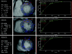 Postcontrast T1 maps of the basal, midcavity, and apical left ventricle in short-axis view of the anterior segment (highlighted in red). An exponential recovery curve of signal intensities at different inversion times (T1) is produced to determine a postcontrast myocardial T1 value for the anterior segment: basal 476 msec, midcavity 439 msec, and apical 418 msec. This can be repeated before and after contrast enhancement for all 16 segments to determine the mean T1 value to quantify the degree of myocardial fibrosis. (Reprinted, with permission, from reference 26.) ROI = region of interest.