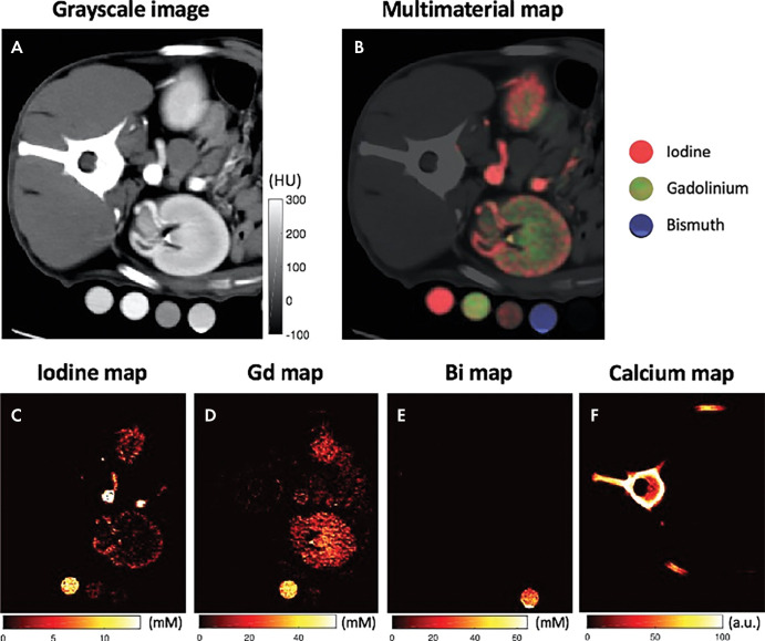 Multicontrast photon-counting CT images in a canine abdomen. A, Gray-scale CT image obtained using photons with single-energy bin. B, Multimaterial map obtained using multienergy reconstruction, labeling iodine, gadolinium, and bismuth with different colors, resulting in different distributions. C, Iodine map alone. D, Gadolinium (Gd)-enhanced map alone. E, Bismuth (Bi) map alone. F, Calcium map alone. (Reprinted, with permission, from reference 55.)