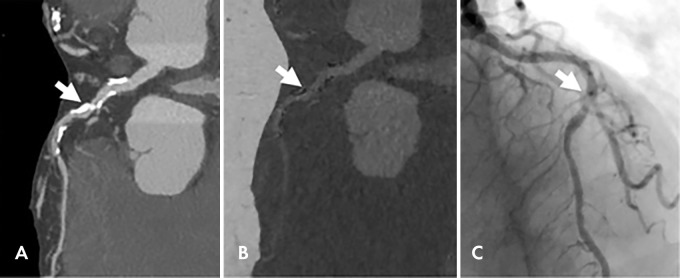 Images in a 92-year-old woman with chest pain. A, Dual-energy coronary CT angiogram. B, Material decomposition–based calcium suppression and, C, corresponding invasive coronary angiogram show a patent lumen visualized with calcium suppression imaging. Arrow indicates the same middle left anterior descending coronary lesion. (Reprinted, with permission, from reference 63.)