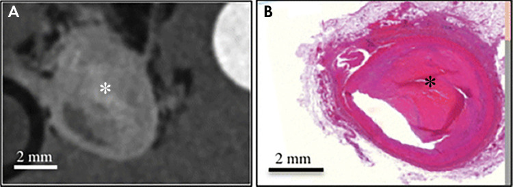 Ex vivo images of complex fibrous material (*) within plaque in the right coronary artery obtained, A, with phase-contrast CT and, B, at histology. (Reprinted, with permission, from reference 95.)