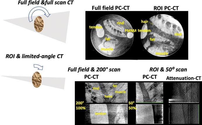 Top: Full-field and region of interest (ROI) phase-contrast CT (PC-CT) scans of fresh pig soft tissues in water at diagnostic energy. The imaged section is 25 mm in diameter. Bottom: Full-field and full-scan phase-contrast CT images and simultaneous region-of-interest and limited-angle phase-contrast tomosynthesis of soft tissues in water. Also shown is the conventional attenuation–based tomosynthesis image, indicating much less soft-tissue contrast than in the phase-contrast image. PMMA = poly(methyl methacrylate).