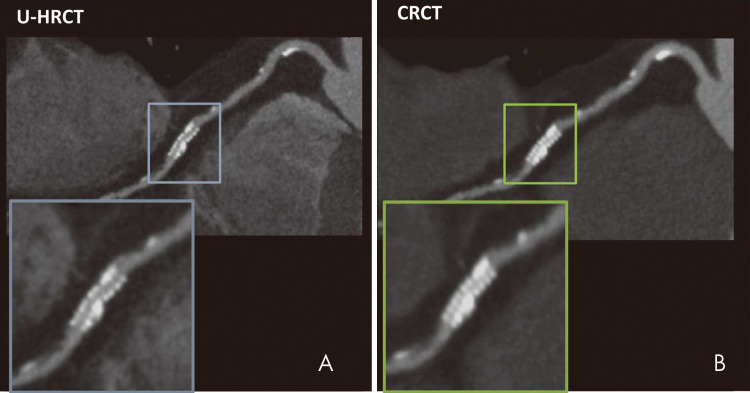 In vivo CT image shows a 2.5-mm stent depicted with, A, ultra-high-resolution CT (U-HRCT) (0.18-mm resolution) and, B, conventional-resolution CT (CRCT) (0.35-mm resolution). (Reprinted, with permission, from reference 30.)