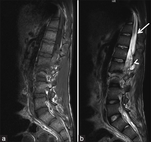 Unusual cord transection in a patient with traumatic spondylolisthesis ...