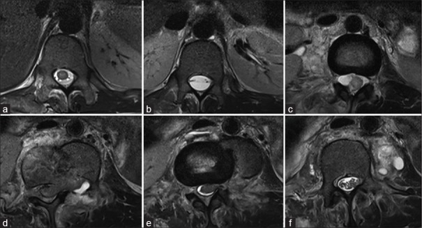 Unusual cord transection in a patient with traumatic spondylolisthesis ...