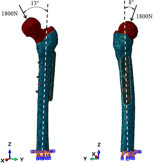 The importance of the thickness of femoral lateral wall for treating ...