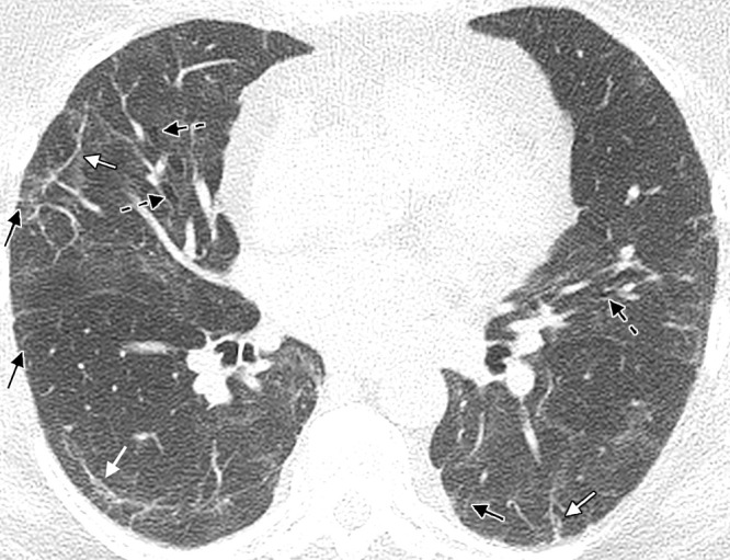 A 60-year-old woman with a history of hospitalization for moderate COVID-19 pneumonia requiring supplemental oxygen but not mechanical ventilation. Axial noncontrast CT image obtained 25 months after presentation for COVID-19 pneumonia shows bilateral thin parenchymal bands (white arrows), peripheral reticulation (black arrows), patchy ground-glass attenuation and reticulation, and traction bronchiectasis with architectural distortion (dashed black arrows). The fibrotic-like findings shown here appear to represent a new baseline given the 2-year period and have a pattern suggesting fibrotic sequelae of organizing lung injury in the setting of COVID-19. In other cases, parenchymal bands, ground-glass opacities, reticulation, and bronchial dilatation improve or resolve at follow-up imaging and cannot be interpreted as irreversible fibrosis without follow-up imaging.