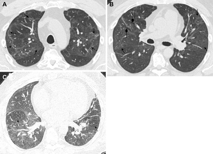 A 51-year-old man 6 months after COVID-19 infection. Axial contrast-enhanced CT images from a series obtained at (A, B) inspiration and (C) expiration. (A) Persistent faint ground-glass opacities scattered throughout the lung parenchyma (solid arrows) have decreased in attenuation since prior imaging but remain extensive (tinted sign). Subpleural curvilinear opacities represent parenchymal bands and perilobular opacities (dashed arrows). (B) Mild anterior varicose bronchiectasis appreciated anteriorly in the right middle lobe (round arrows). Faint persistent ground-glass opacities (solid arrows). (C) Lobular and regional areas of persistent low attenuation (dashed arrows) on expiratory images consistent with air trapping, suggestive of small airway disease.