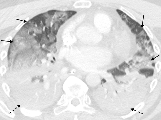 A 51-year-old man with COVID-19 infection. Axial contrast-enhanced CT image obtained the week of initial presentation after intensive care unit transfer. There is dense consolidation within the dependent portions of the lungs bilaterally (dashed arrows) and multifocal ground-glass opacity within the nondependent portions of the lungs (solid arrows). These findings are suggestive of a diffuse alveolar damage pattern of lung injury.