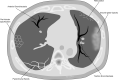 Commonly seen chronic CT findings after COVID-19 infection.