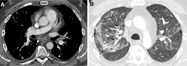 A 51-year-old man 6 months after COVID-19 infection with shortness of breath. Axial CT pulmonary angiograms obtained with (A) soft-tissue and (B) lung window settings at second acute presentation to the emergency department. There are filling defects within several pulmonary artery branches (solid white arrows), consistent with acute pulmonary emboli. Multifocal patchy and linear ground-glass opacities and consolidation (solid black arrows) are new from 2 weeks prior. New bronchial wall thickening (dashed black arrows) and bilateral small pleural effusions (dashed white arrows). These findings suggest a superimposed acute process.