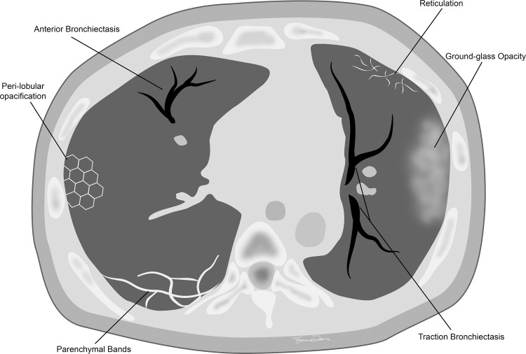 Commonly seen chronic CT findings after COVID-19 infection.