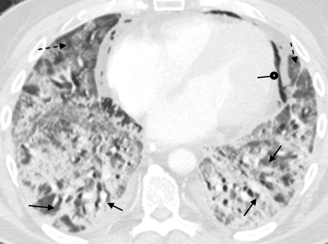 A 51-year-old man with COVID-19 infection. Axial contrast-enhanced CT image obtained 1 month after initial presentation. There is improved aeration of the dependent portions of the lungs; however, there is residual consolidation with contraction and architectural distortion (solid arrows). There is also persistent ground-glass opacity (dashed arrows) and new bronchial dilatation bilaterally. This appearance is suggestive of the organizing phase of acute lung injury. There is pneumomediastinum (round arrow) likely secondary to barotrauma from mechanical ventilation.