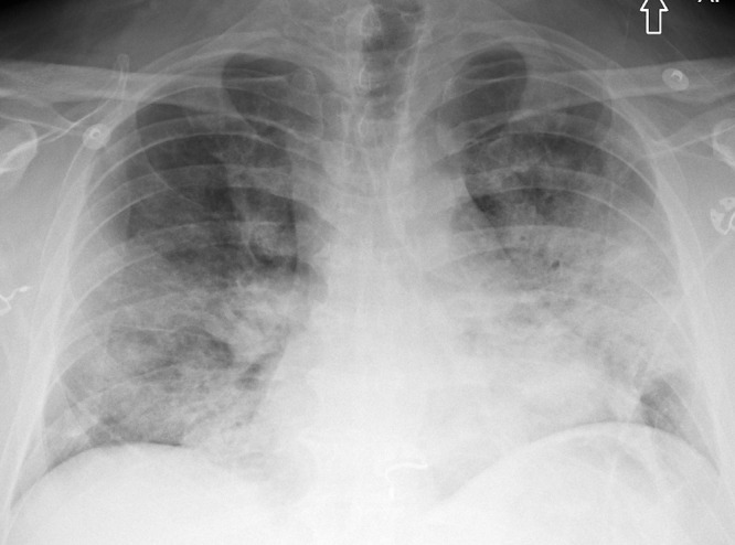 A 51-year-old man with COVID-19 infection. Anteroposterior chest radiograph shows extensive pulmonary opacities bilaterally with a lower lung and peripheral predominance.