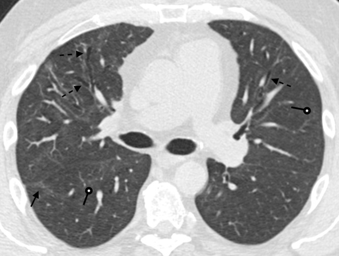 A 51-year-old man 9 months after COVID-19 infection. Axial contrast-enhanced CT image shows mild persistent anterior varicose bronchiectasis and architectural distortion best appreciated in the right middle lobe (dashed arrows). Faint patchy ground-glass opacities and reticulation are improved from 6-month imaging and barely perceptible (round arrows). Faint linear parenchymal bands have greatly improved (solid arrow). This may reflect the patient's new baseline.