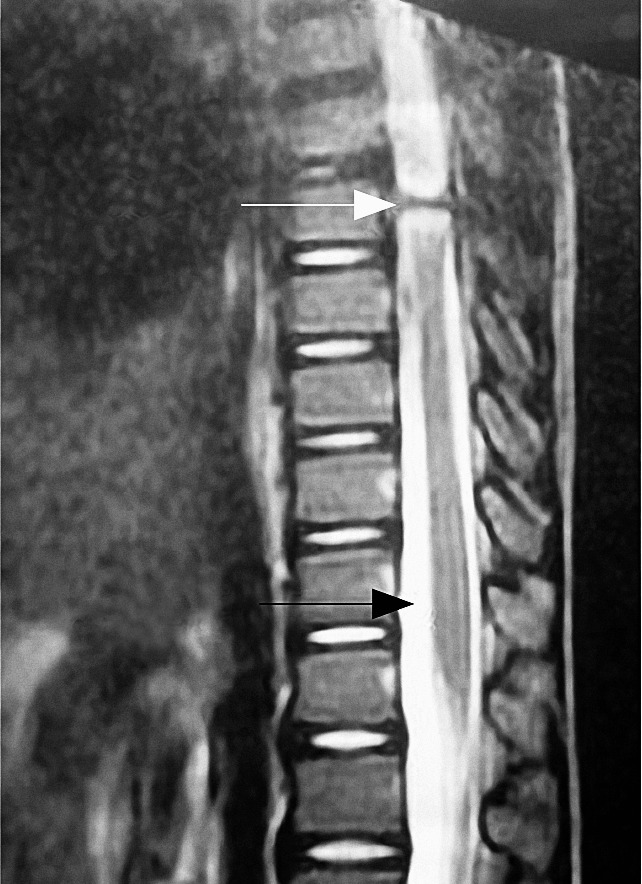 T8 spinal cord transection in a 6-year-old child - PMC