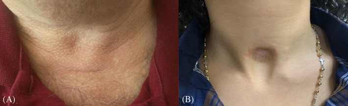 Evaluation of post‐tracheostomy scars and their impact on persons ...