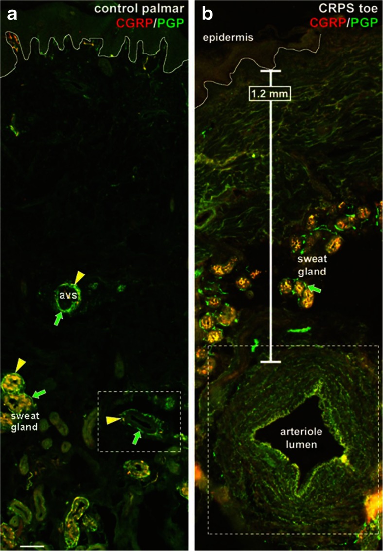 Immunotherapy Prospects for Painful Small-fiber Sensory Neuropathies ...