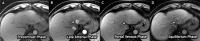 (A–D) Three-dimensional axial dynamic contrast-enhanced
T1-weighted images (liver acquisition with volume acquisition, or LAVA) with
frequency-selective fat suppression acquired on a 1.5-T GE Signa HDxt
scanner in a 64-year-old man with Child-Pugh class A cirrhosis from chronic
hepatitis C infection. Examination quality was rated as adequate by both
readers. The images from this simulated dynamic abbreviated MRI examination
demonstrate a 2.1-cm observation (arrow) in segment II with nonrim arterial
phase hyper-enhancement (A) and delayed washout (C), classified as Liver
Imaging Reporting and Data System category LR-5 and confirmed as poorly
differentiated hepatocellular carcinoma on the left lobectomy surgical
specimen.