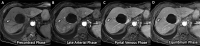 (A–D) Three-dimensional axial dynamic contrast-enhanced
T1-weighted images (mDixon sequence) acquired on a 1.5-T Philips Ingenia
scanner in a 66-year-old woman with Child-Pugh class C cirrhosis from
alcohol use. Examination quality was rated as adequate by both readers. The
images from this simulated dynamic abbreviated MRI examination demonstrate
no high-risk (Liver Imaging Reporting and Data System category LR-4, LR-5,
or LR-M) observation but show a T1-hypointense observation (arrow) in the
periphery of segment VII, with enlarging peripheral nodular enhancement at
sequential postcontrast phases consistent with hemangioma, as well as a
simple cyst. These findings, including the absence of hepatocellular
carcinoma, were confirmed on the liver explant specimen.