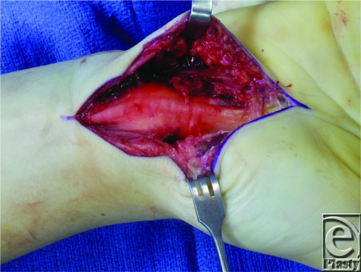 graphic file with name eplasty13ic08_fig1.jpg