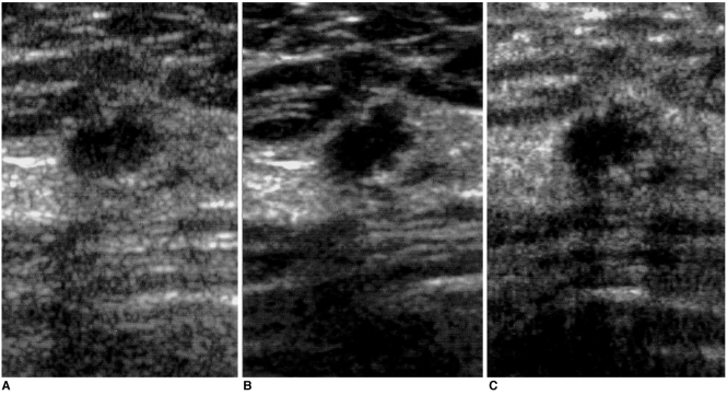 Sonographic Evaluation of Breast Nodules: Comparison of Conventional ...