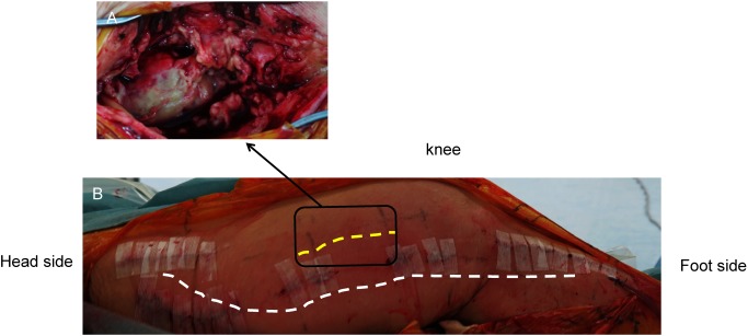 Fig. 2 (A) An edematous and fragile aneurysm wall. Transmission and infection of the surrounding soft tissue and muscle tissue. (B) Wounds of the aneurysm approach and bypass wounds were separated as far as possible to prevent infection.