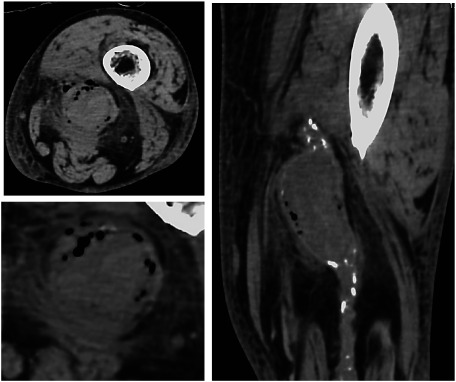 Fig. 1 Preoperative computed tomography revealed left popliteal artery pseudoaneurysm with a gas shadow. The soft tissue shadow around the aneurysm was enhanced.