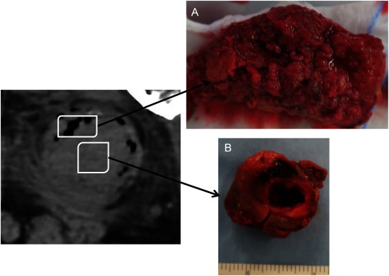 Fig. 3 (A) Small holes consistent with the gas image on computed tomography of the thrombus outside the aneurysm. (B) Internal lumen. Uniform thrombus inside the aneurysm.