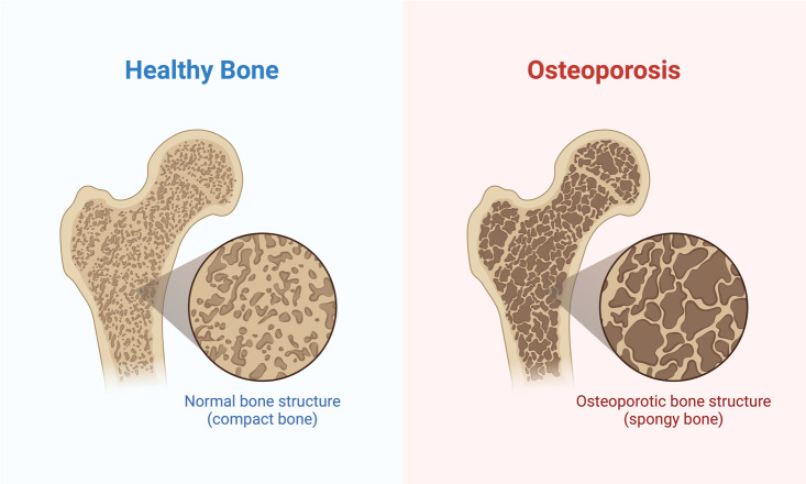 A comparison of bones with different types of bones Description automatically generated