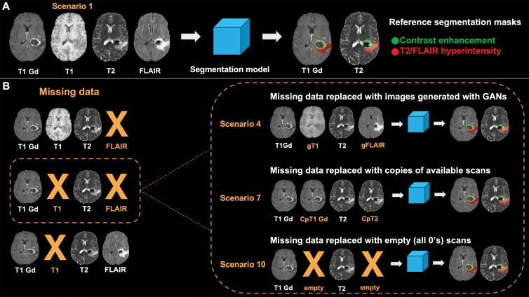 Lesion segmentation. T1 Gd = postcontrast T1-weighted image, FLAIR = fluid-attenuated inversion recovery. A, Segmentation model requires four MRI sequences (postcontrast T1-weighted, precontrast T1-weighted, T2-weighted, and FLAIR imaging) as inputs to obtain masks of contrast-enhanced areas and areas of T2 and FLAIR hyperintensity in lesions. Masks obtained with original MRI scans serve as reference in comparison with those obtained in different scenarios. B, In case both precontrast T1-weighted and FLAIR images are missing, we simulated three different scenarios. Both precontrast T1-weighted and FLAIR images are replaced with those generated with generative adversarial networks (GANs) (scenario 4), replaced with copies of available MRI scans (scenario 7), or are left empty (scenario 10). Segmentations obtained in these scenarios are compared with those obtained using only original scans. A similar approach was used when only FLAIR images or T1-weighted images were missing (not shown). CpT1 Gd = copy of postcontrast T1-weighted image, CpT2 = copy of T2-weighted image, gFLAIR = FLAIR image generated with GANS, gT1 = T1-weighted image generated with GANS.