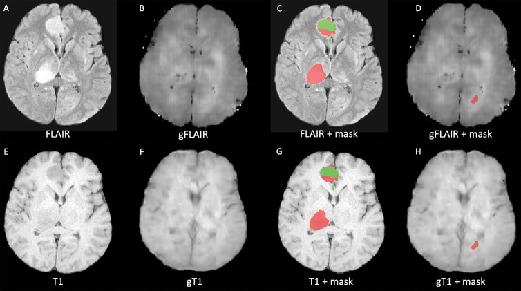 Examples of low-quality segmentation. A, Original fluid-attenuated inversion recovery (FLAIR) MRI scan, B, FLAIR MRI scan generated with generative adversarial network (GAN) (gFLAIR), E, T1-weighted MRI scan, and, F, T1-weighted MRI scan generated with GAN (gT1) created by our models. D, H, Segmentation of lesion obtained with generated FLAIR image and generated T1-weighted image instead of original MRI scans is different from, C, G, segmentation obtained using only original MRI scans that served as reference, with dice similarity coefficient of 0.23. Red indicates segmentation of T2 and/or FLAIR hyperintensity. Green area indicates segmentation of enhanced area of lesion.