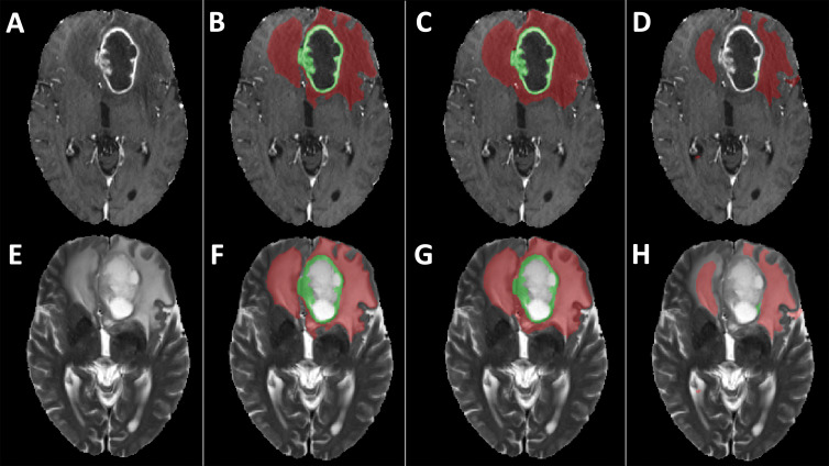 Examples of segmentation masks. A–D, Postcontrast T1-weighted images and, E–H, T2-weighted images of glioblastoma from Multimodal Brain Tumor Segmentation Challenge test set. Segmentation masks of contrast-enhanced area (green) and T2 hyperintense area (red) obtained, B, F, with segmentation model using only original scans as inputs (scenario 1), C, G, using images generated with generative adversarial networks (GANs) (scenario 4), and, D, H, using copies of other scans (scenario 7). Use of only empty scans (scenario 10) failed to produce any masks (not shown). When compared with ground truth segmentations (B, F), dice similarity coefficient for whole segmentation masks obtained with GANs (C, G) was 0.88, whereas dice similarity coefficient obtained with copies of other available scans (D, H) was 0.56.