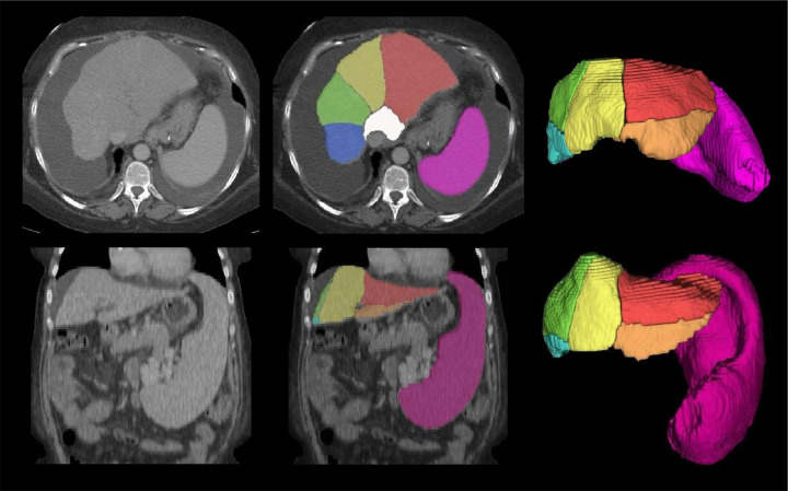 CT scans show examples of automated liver segments and spleen volume measurements in challenging cases. Automated segmentation of the eight liver Couinaud segments (six segments visible: white, red, orange, yellow, green, and blue) and spleen (pink) in two challenging cases from dataset 1, shown in axial (top row, first case) and coronal (bottom row, second case) contrast-enhanced CT scans: a 55-year-old woman with chronic hepatitis C virus (HCV) infection (METAVIR F4) and abundant ascites (top row) and a 49-year-old woman with chronic HCV infection (METAVIR F4) and prominent splenomegaly (bottom row). Challenging cases were defined as cases where the primitive deep learning model failed to segment the liver and spleen because of ascites and splenomegaly.