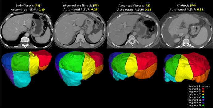 CT scans show examples of automated liver Couinaud segment measurements. Automated segmentation of the eight liver Couinaud segments (I–VIII) in four different stages of liver fibrosis according to the METAVIR scale from dataset 1, shown on axial contrast-enhanced CT scans: F1 (54-year-old man with chronic hepatitis C virus [HCV] infection), F2 (51-year-old man with HCV infection), F3 (46-year-old man with chronic HCV infection), and F4 (55-year-old woman with chronic HCV infection). The liver segmental volume ratio (LSVR) was larger in higher grades. *LSVR = a ratio of the volume of segments I–III to segments IV–VIII.