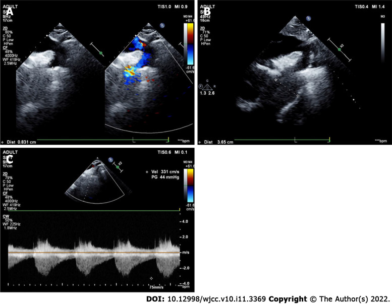 Echocardiography in the diagnosis of Shone’s complex and analysis of ...