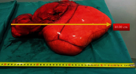 Giant Abdominal Lipoma in Adult - PMC