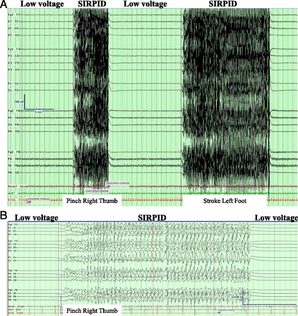 FIGURE 1. EEG of the study patient demonstrating low voltages with bursts of SIRPIDs during stimulation (pinch right thumb and stroke left foot). A, Compressed EEG. B, Uncompressed EEG.