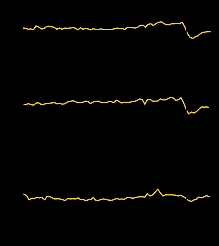 The figure is a line chart showing the number of emergency department visits for myocardial infarction, stroke, and hyperglycemic crisis, in the United States, during week 1, 2019–week 21, 2020.