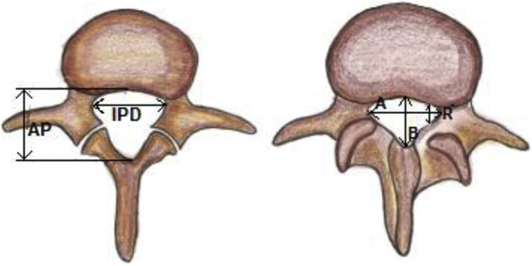 Fusion Surgery for Lumbar Spinal Stenosis: WFNS Spine Committee ...