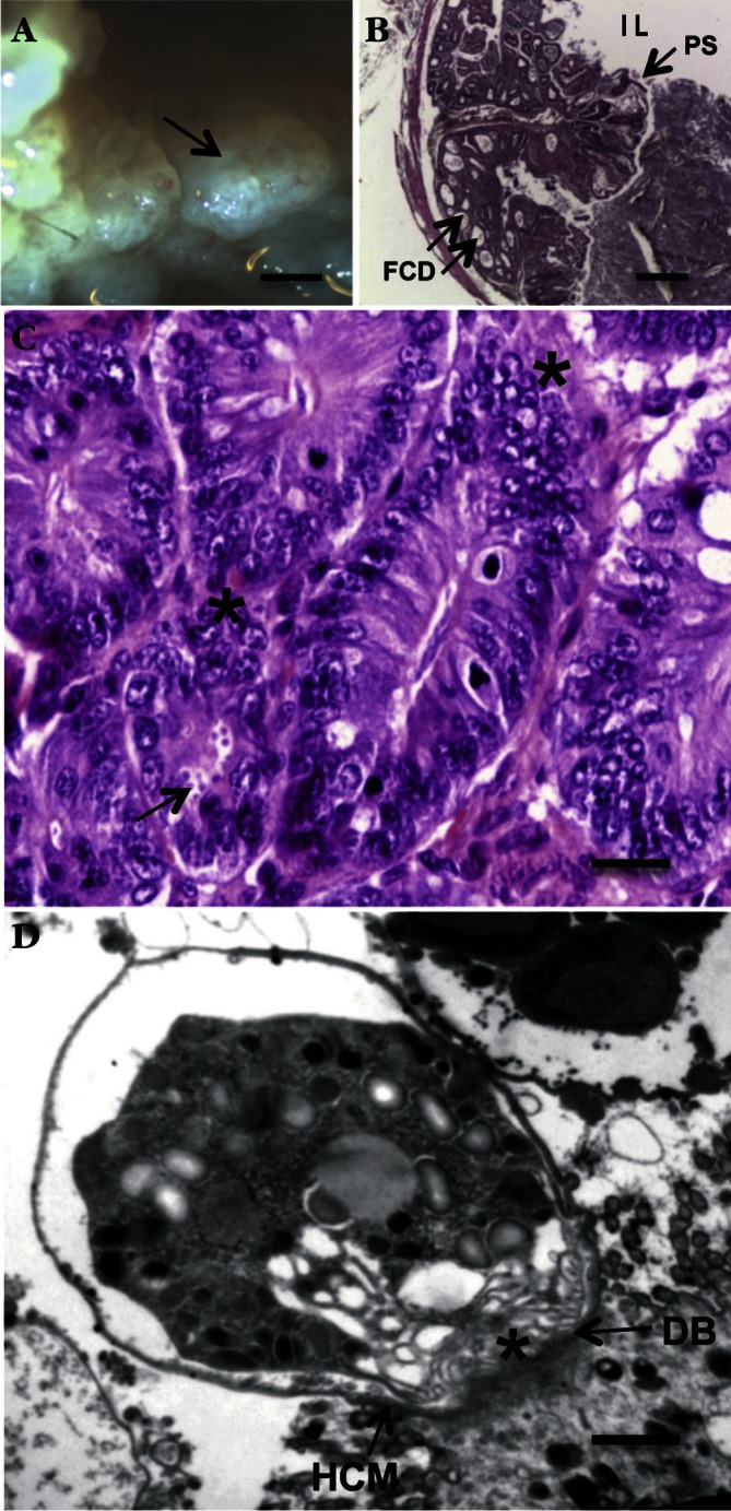 Parasites and malignancies, a review, with emphasis on digestive cancer ...