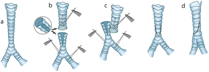 Reconstruction of the trachea and carina: Surgical reconstruction ...