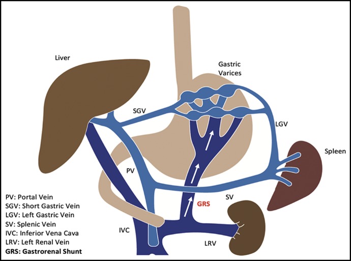 Endoscopic Ultrasound-Guided Coil Injection Therapy for Gastric ...