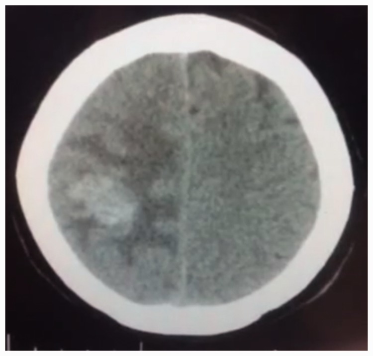 Calcified brain metastatic adenocarcinoma: A case report and review of ...