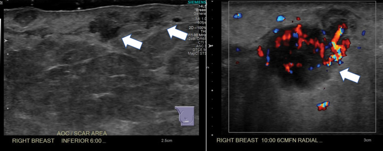 Skin recurrence in a patient with a history of skin-sparing mastectomy and deep inferior epigastric perforator (DIEP) flap reconstruction. (a) Photograph of the reconstructed right breast shows ­erythema and multiple palpable skin nodules at the 10-o’clock position and along the vertical surgical scar at the 6-o’clock position. (b) Gray-scale (left) and color Doppler (right) US images of the right breast show irregular hypoechoic masses (arrows in left image) in the dermal and subdermal layer with hypervascularity (arrow in right image). (c) Axial CT image shows multiple subcutaneous enhancing nodules (arrowheads), which correlate with the US findings.