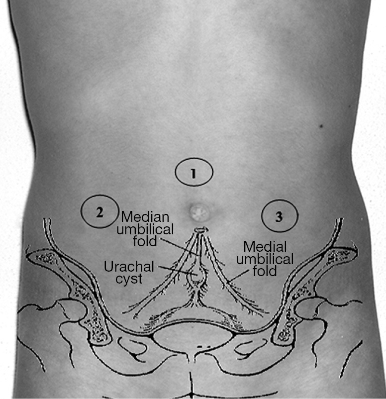 Laparoscopic management of urachal cysts - PMC